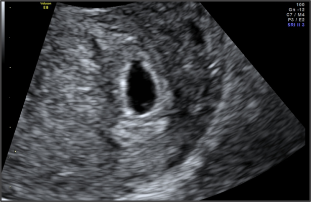 5 Weeks 3 days ultrasound scan picture